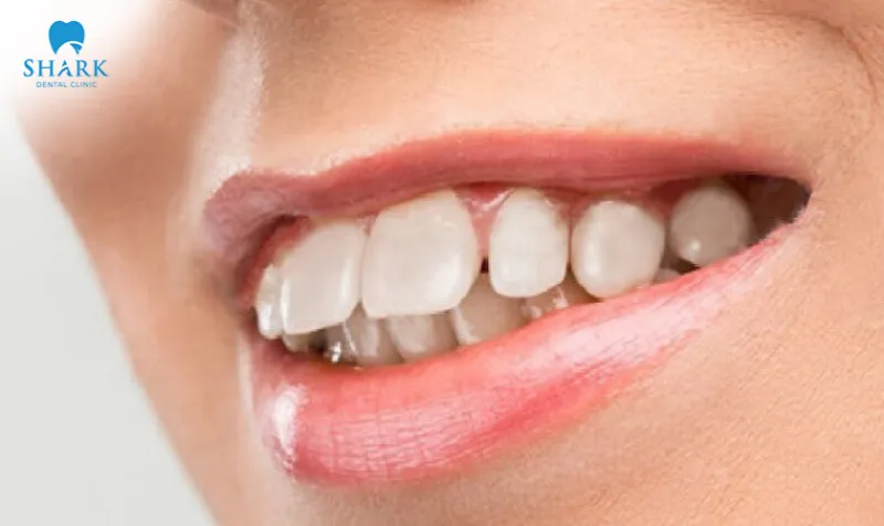 There are various underlying causes of an overbite condition, and the dentist will perform an examination to determine the most appropriate treatment approach