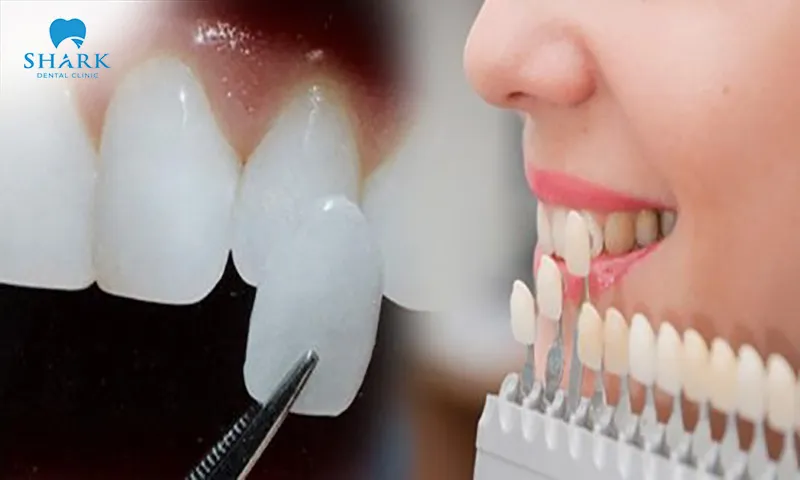 If the overbite is caused by the jaw structure, veneers are not able to correct or address the issue