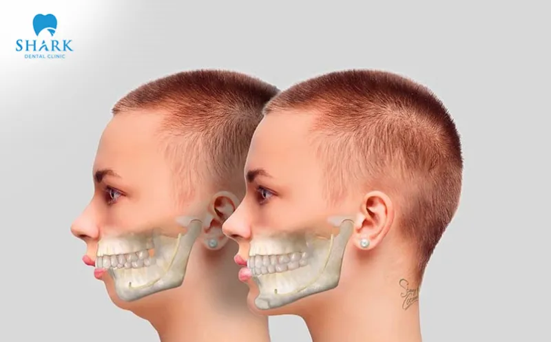 Jaw surgery is indicated for cases of severe overbite where the bite alignment is not properly matched and lacks harmony