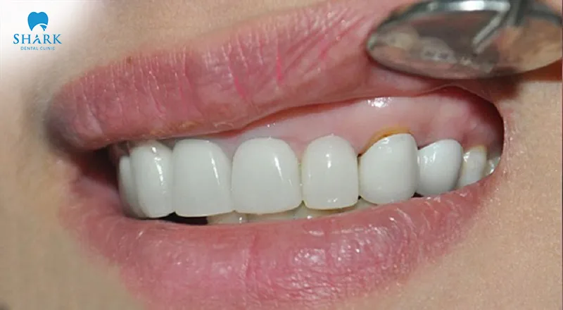 Tooth decay beneath veneers can present with noticeable signs that may be recognized through visible changes in the teeth’s appearance