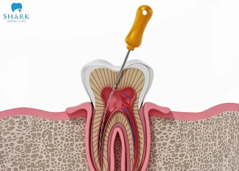 Root canal treatment is a dental procedure that involves removing the inflamed, infected, or dead pulp tissue from inside the tooth to eliminate the source of damage