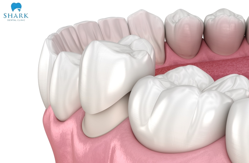 Dental crowns are a restorative solution that use a custom-made porcelain cap placed over a prepared natural tooth to help correct defects and restore appearance
