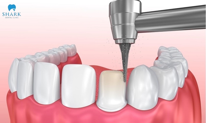 The dental crown method requires the removal of a portion of the natural enamel, which can make the underlying tooth structure weaker over time