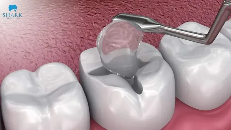 Glass ionomer is also considered one of the commonly recommended options among permanent tooth filling cements, depending on the specific condition and requirements