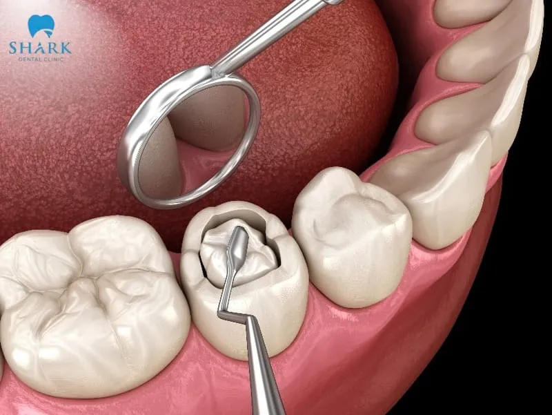 In the treatment of cracked or fractured teeth, dentists typically use two types of filling materials—temporary and permanent—each serving a distinct purpose within the overall treatment process