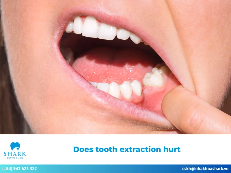 Does tooth extraction hurt? How to manage pain safely?