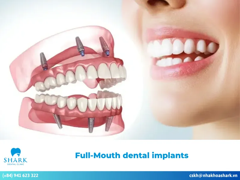 What are full-mouth dental implants? Reputable dental clinic