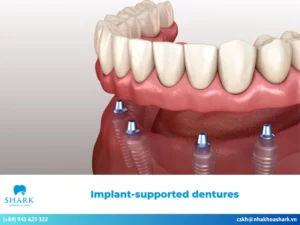 What are implant-supported dentures? Outstanding pros & cons