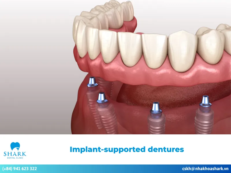 What are implant-supported dentures? Outstanding pros & cons
