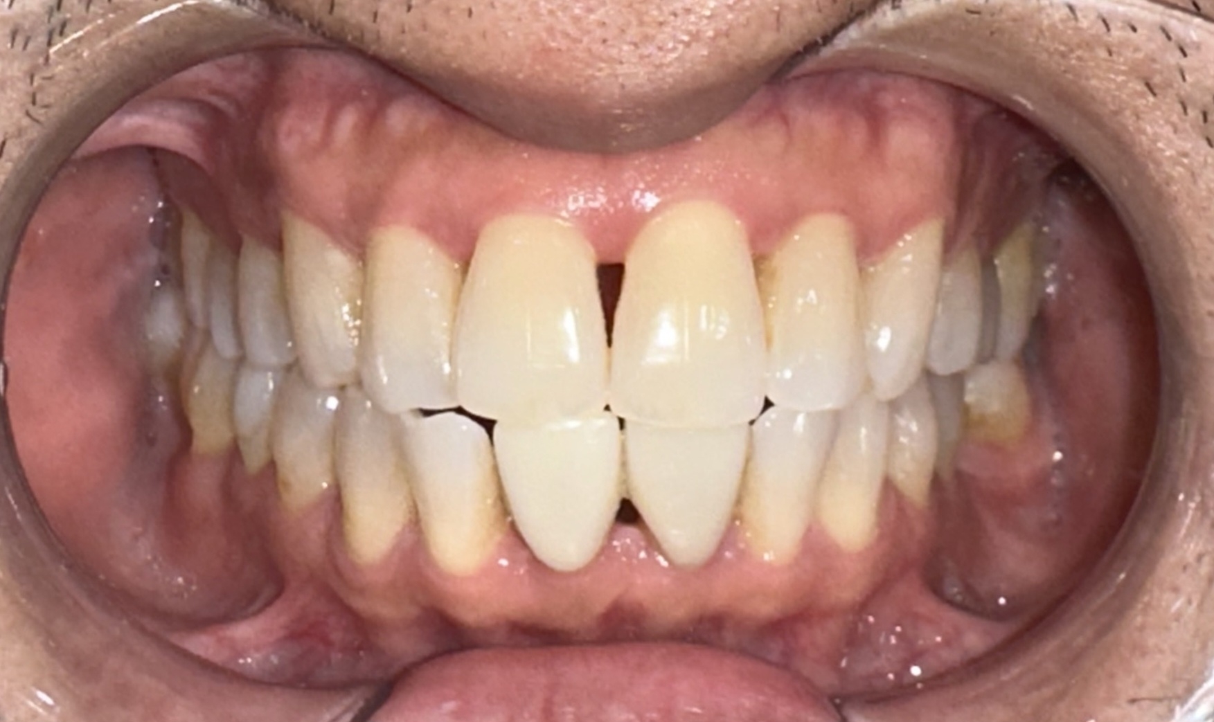 Client before procedure, front view