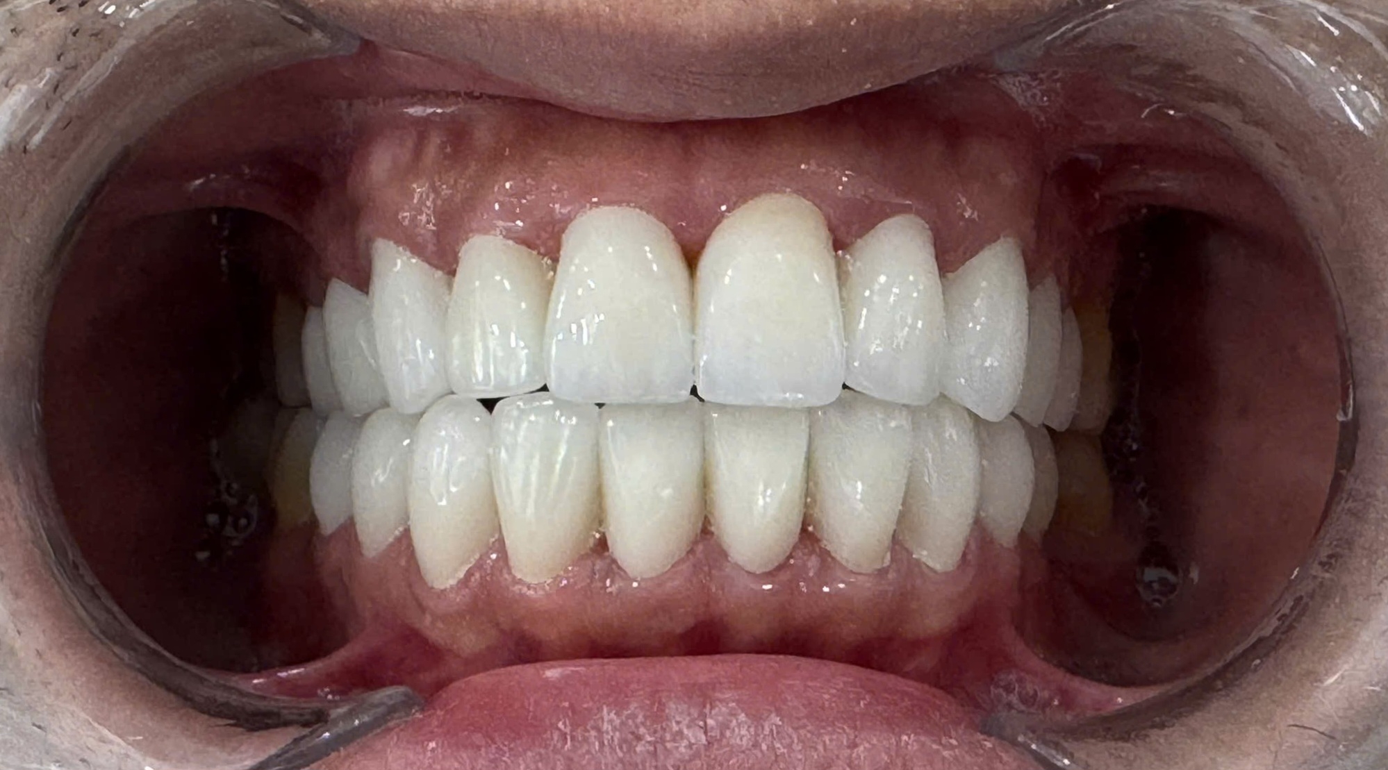 Client after procedure, side angle