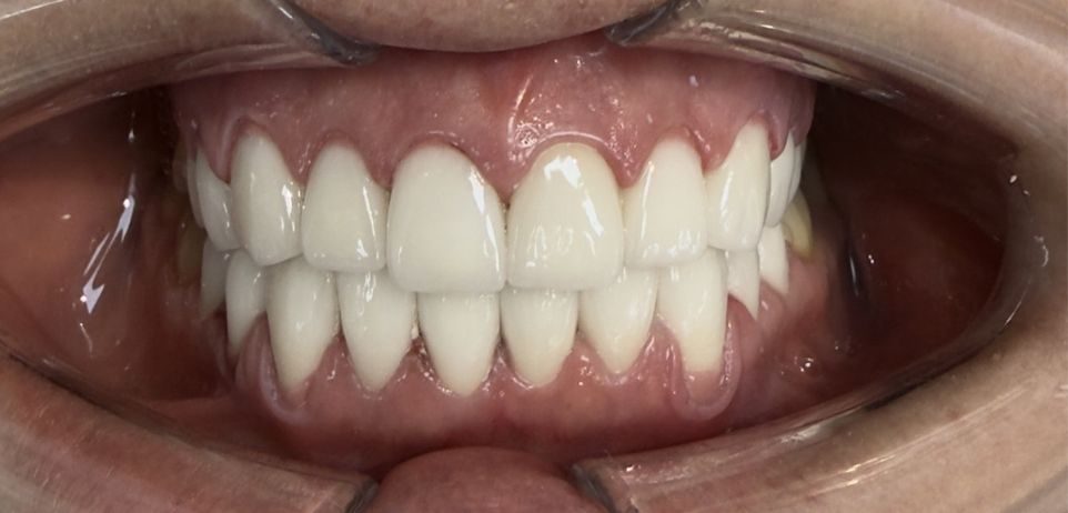 Client after procedure, side angle