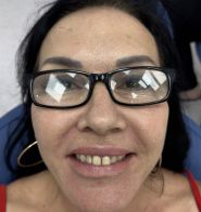 Client Rachelle before procedure 