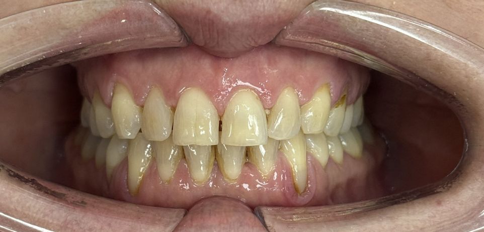 Client before procedure, front view