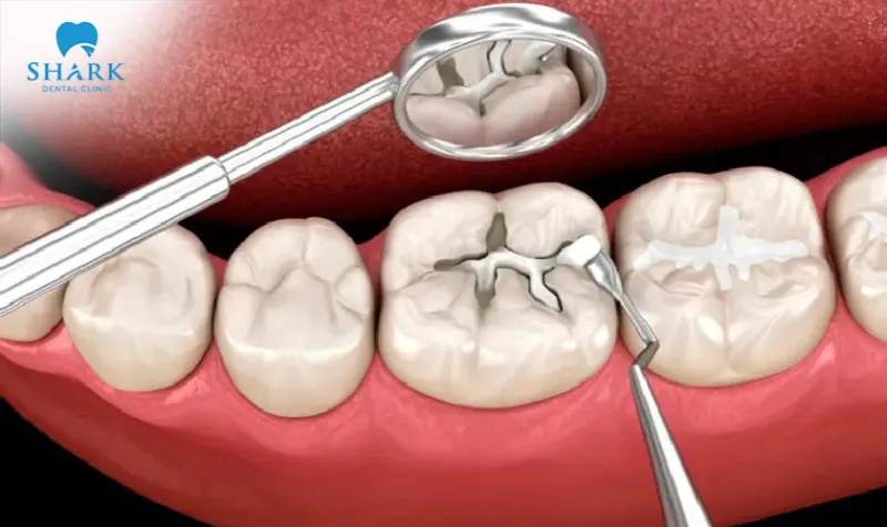 Tooth decay under filling can lead to infection, pain, and may negatively affect overall oral health if not addressed properly