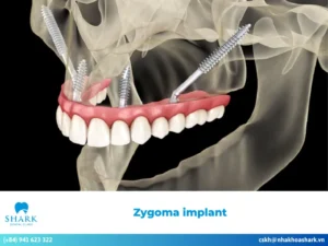 Zygoma implant – An advanced dental technique today