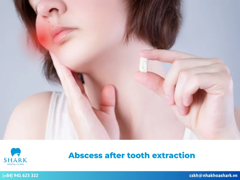 Is an abscess after tooth extraction dangerous? Safe treatment