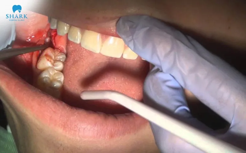 This condition can cause gum swelling that may last from several days to a few weeks, depending on the size of the abscess and the severity of the prior infection