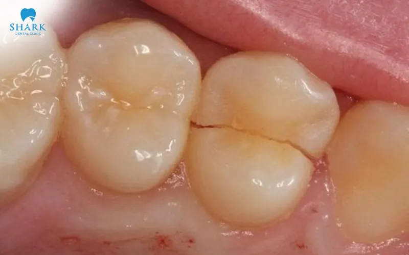 Broken or cracked teeth are potential causes that can lead to infection and eventually result in a tooth abscess