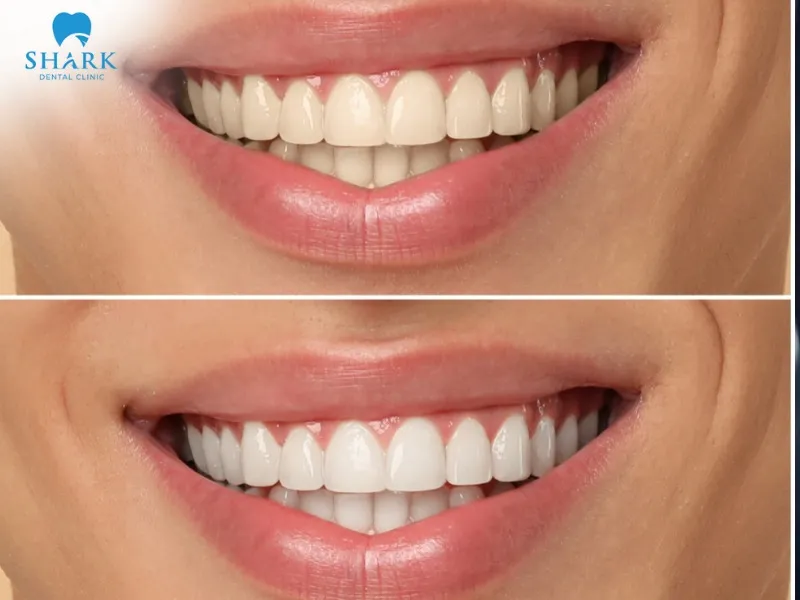 If you consume coffee frequently, your teeth may gradually become stained, leading to yellowing and a return of discoloration over time
