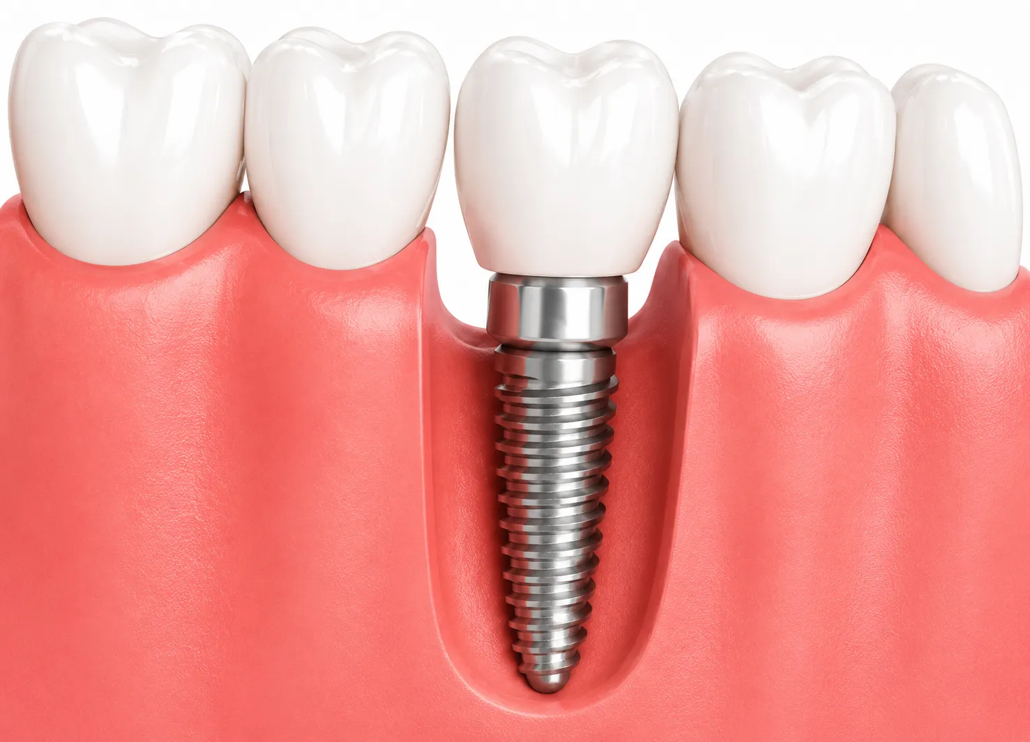 Implant