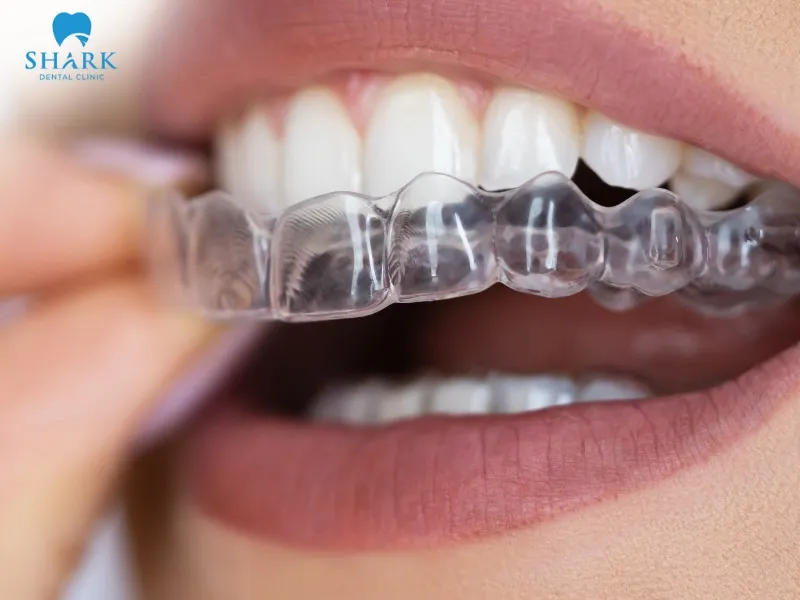 Clear aligner orthodontic treatment helps gradually correct misaligned teeth and guide them into their proper positions over time