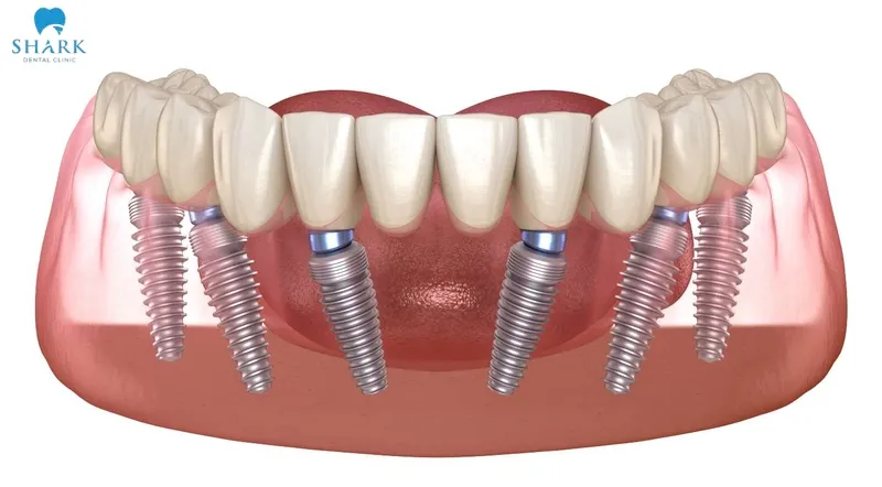 It cannot be stated in absolute terms that German dental implant brands are always better than Korean implant systems, as the most suitable choice depends on each individual case and treatment needs