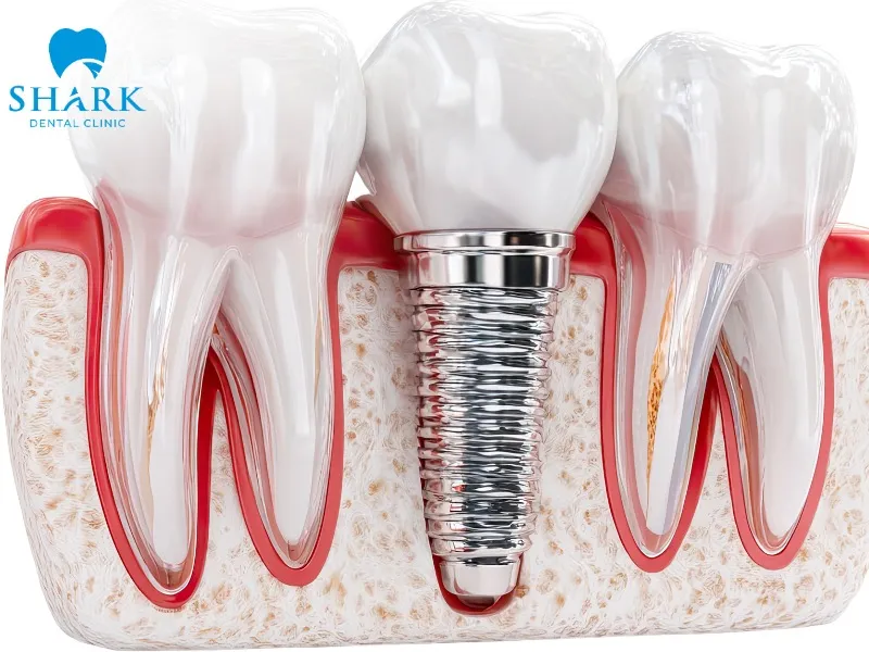 Korean dental implants are known for their affordable cost, good aesthetic outcomes, and suitability for a wide range of patients and clinical situations