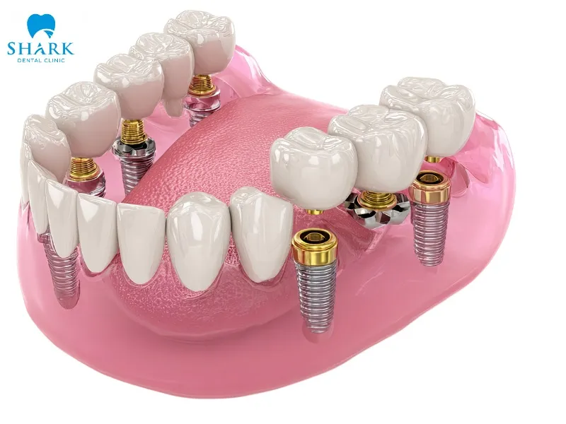 All-on-4 and All-on-6 full-mouth implant techniques are currently two of the most commonly applied methods in modern dentistry