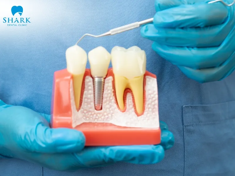 Full mouth dental implants are considered a modern restorative solution that helps effectively restore chewing function and improve oral comfort