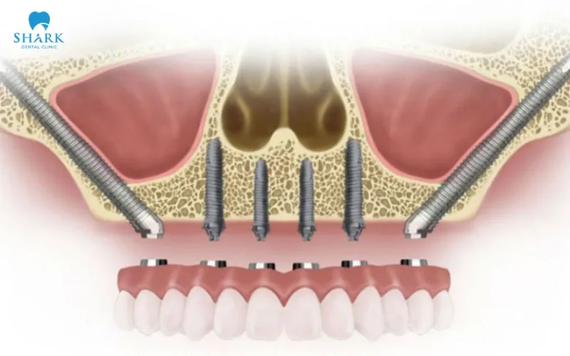 It works based on biomechanical principles by utilizing the dense and strong structure of the zygomatic bone to create a secure anchoring point for the implant post