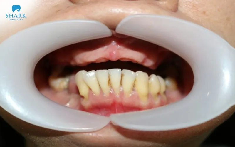 This technique is suitable for cases involving full upper arch tooth loss combined with severe jawbone resorption