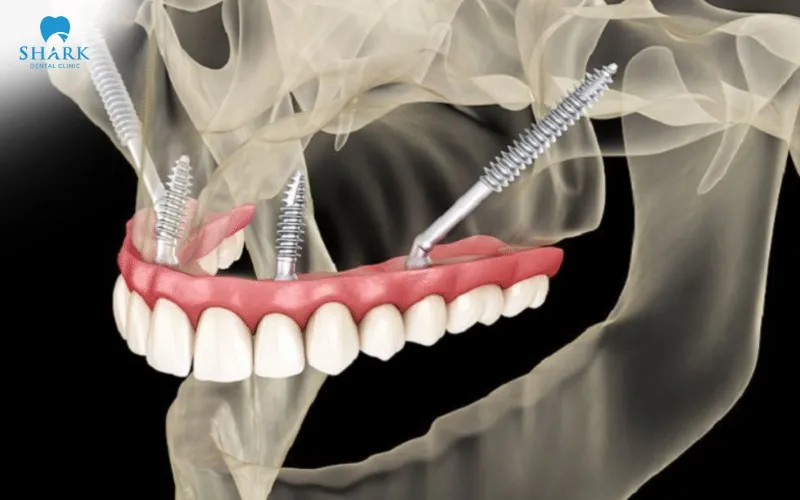 This method helps shorten the treatment timeline by reducing the need for additional procedures such as bone grafting or sinus lift surgery