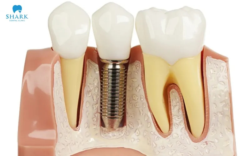 Once the required level of stability has been achieved, the dentist will take impressions and place the fixed porcelain restoration to complete the overall treatment process