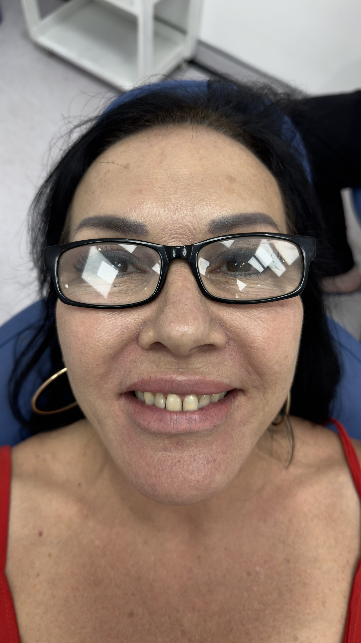 Client before procedure , side angle