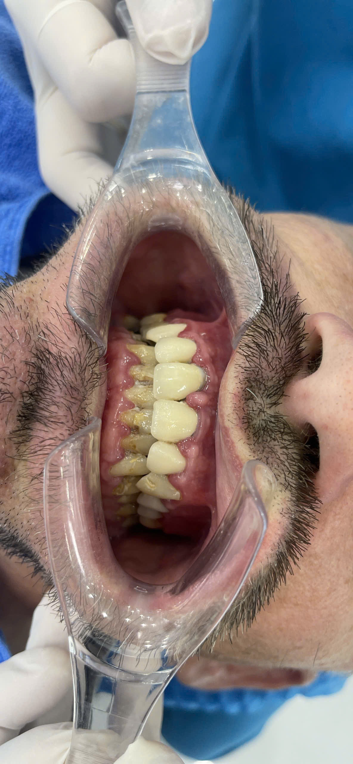 Client before procedure, front view