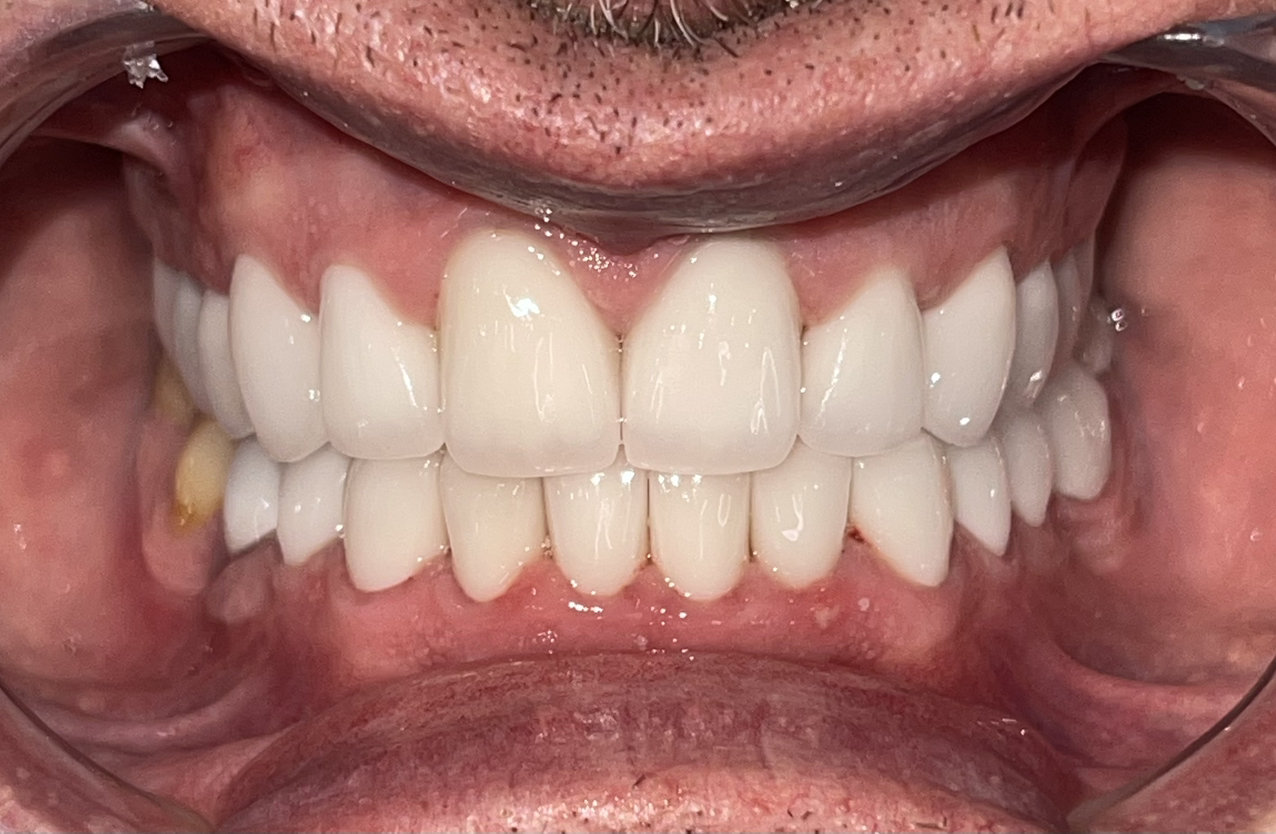 Client after procedure, side angle