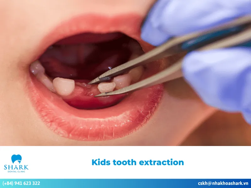 Kids tooth extraction: Guidelines for ensuring patient safety