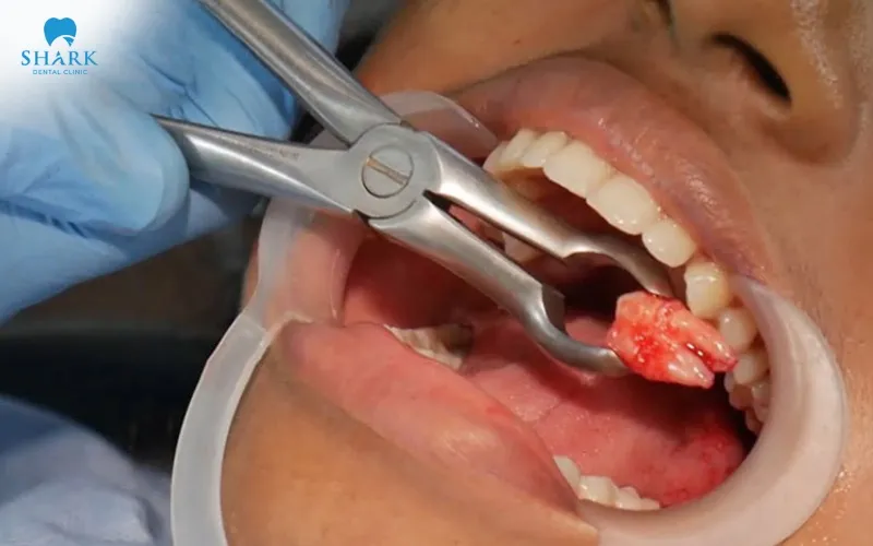 Lower tooth extraction, especially in the case of wisdom teeth, often tends to be more painful and complex compared to upper tooth extraction
