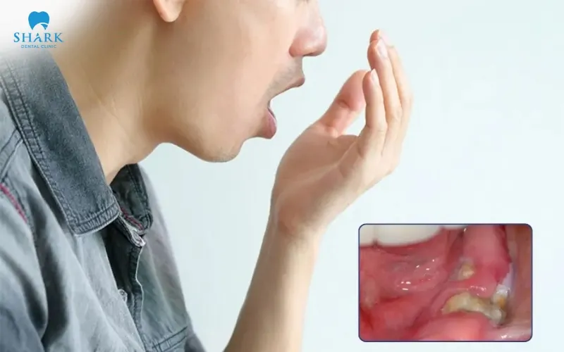 The appearance of swelling and pain accompanied by bad odor or an unpleasant taste in the mouth are abnormal signs after tooth extraction that may indicate complications