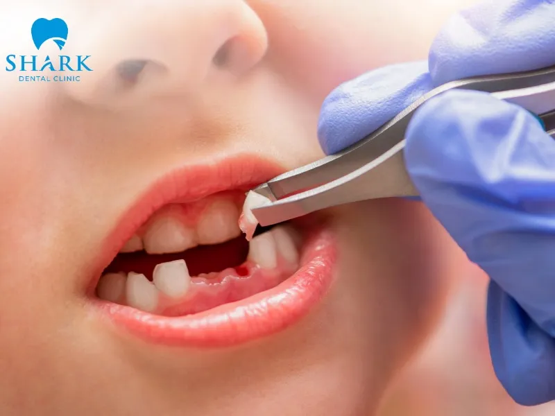 The kids tooth extraction process must follow standard steps according to proper regulations