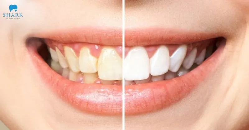 Using teeth whitening mouthwash consistently and regularly can help support a gradual improvement in tooth brightness over time