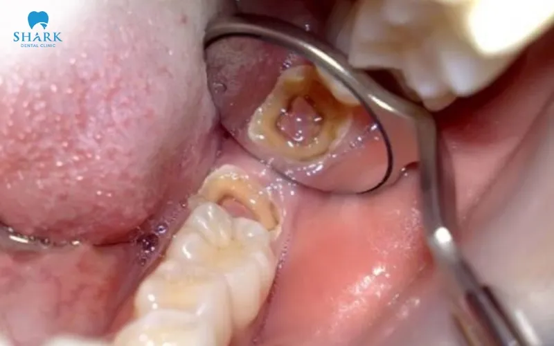 One common cause of a broken wisdom tooth is tooth decay, which can weaken the enamel structure and make the tooth more vulnerable to fracture