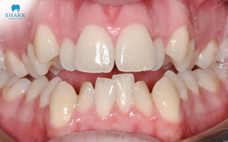 A wisdom tooth broken can place pressure on the teeth in front of it, causing shifting, crowding, or changes in alignment over time