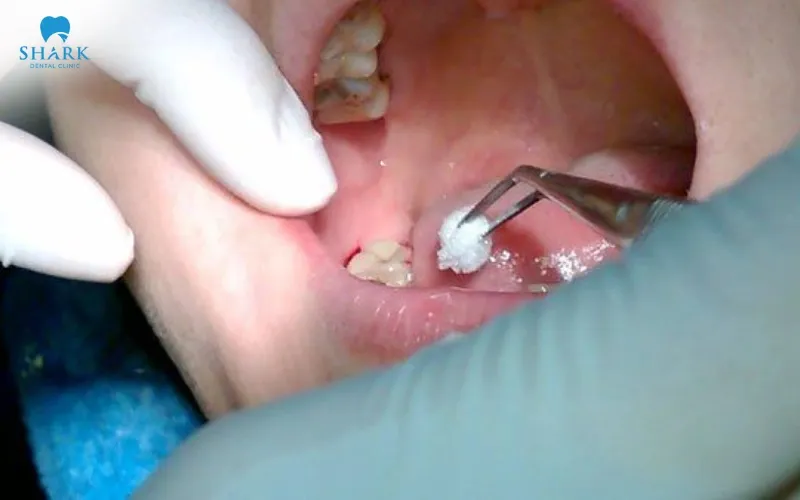 In cases where the broken wisdom tooth is deeply damaged or severely compromised, tooth extraction may be recommended to help ensure overall oral health and safety