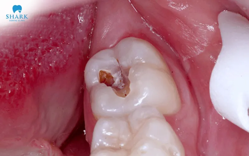 The treatment cost for a wisdom tooth broken currently varies flexibly and may differ depending on the specific condition, treatment method, and clinical complexity