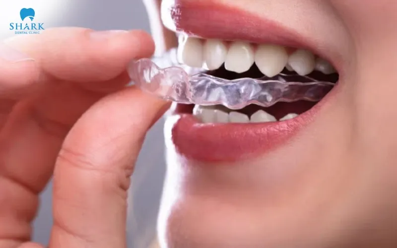 If you have a habit of grinding your teeth during sleep, you should use a protective night guard to reduce pressure and help protect your teeth from damage