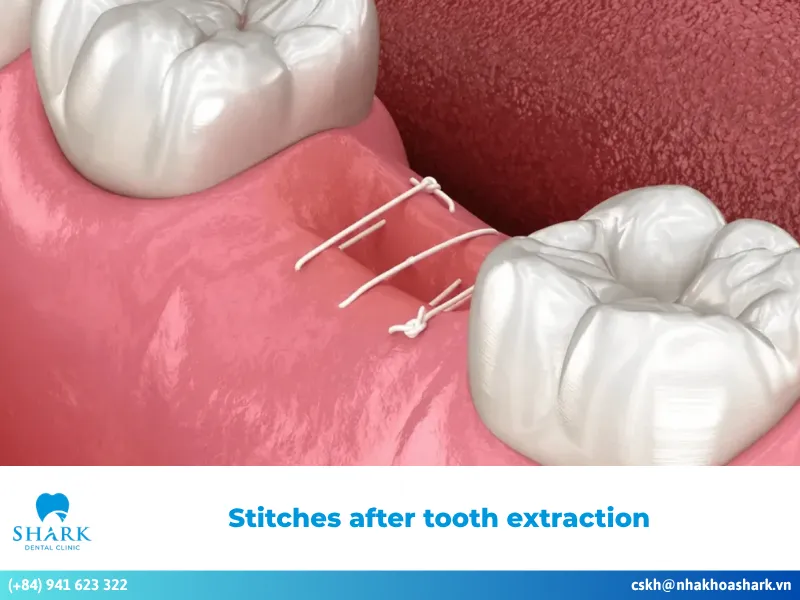 Stitches after tooth extraction – Safe and effective aftercare