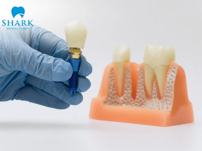 If the child’s jawbone is too weak or not fully developed, the implant post may fail to integrate and could fail to integrate with the jawbone