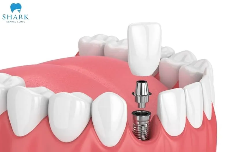Adin dental implants are highly rated by specialists because they offer many notable features, helping provide stable, reliable, and long-lasting tooth restoration results over time